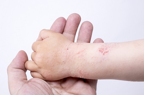 Trẻ em bị viêm da cơ địa