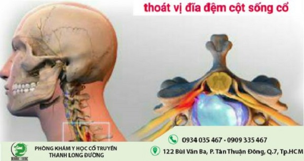 Những phương pháp giúp hạn chế thoát vị đĩa đệm hiệu quả