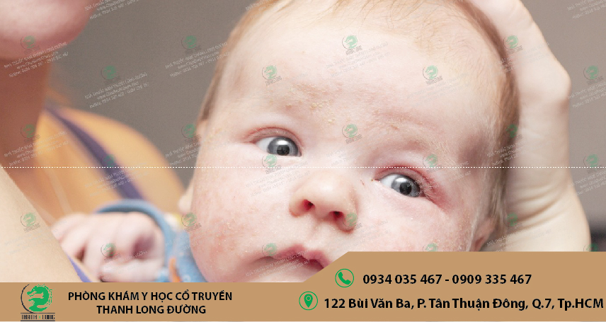 Cách phòng tránh bệnh chàm trẻ em sao cho phù hợp