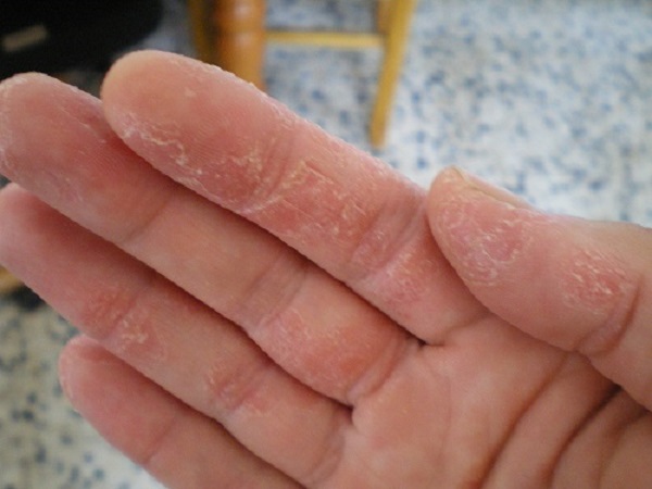 Những cách chữa điều trị viêm da tiếp xúc sao cho hiệu quả.
